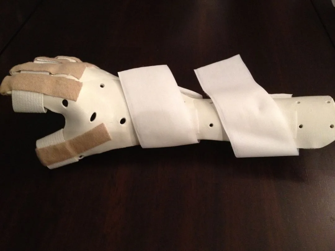 A custom-fabricated thermoplastic hand and wrist splint with straps