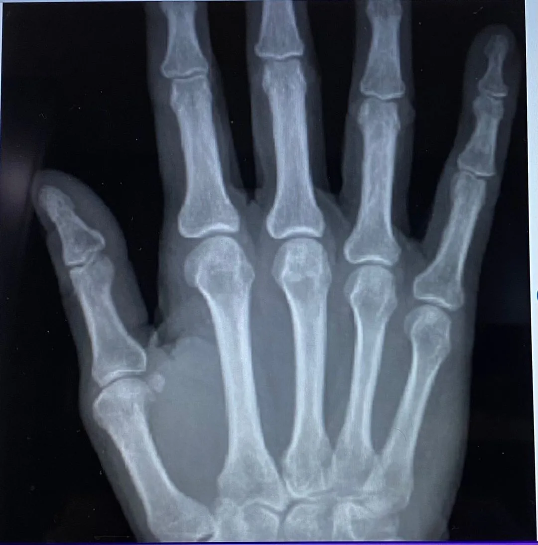 X-ray of a hand showing the bones